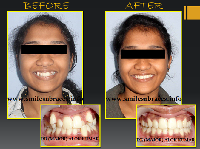 Crooked Teeth Treated By Dental Braces SmilesNBraces