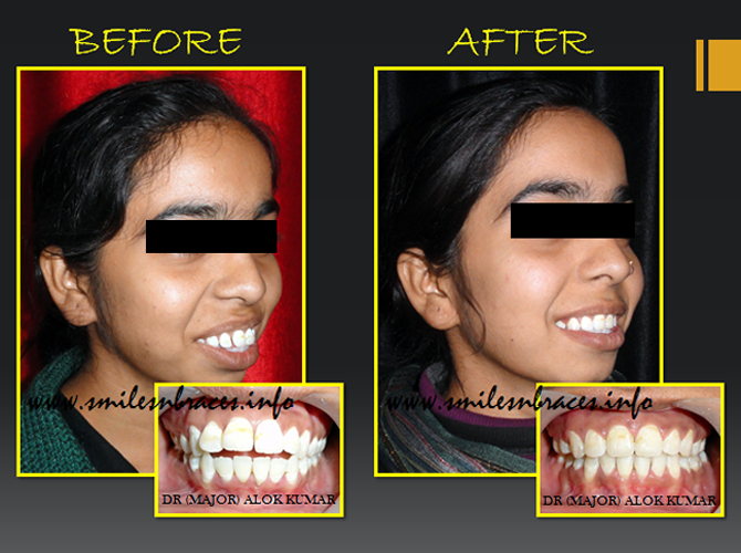 Midline Diastema With High Frenum Corrected SmilesNBraces